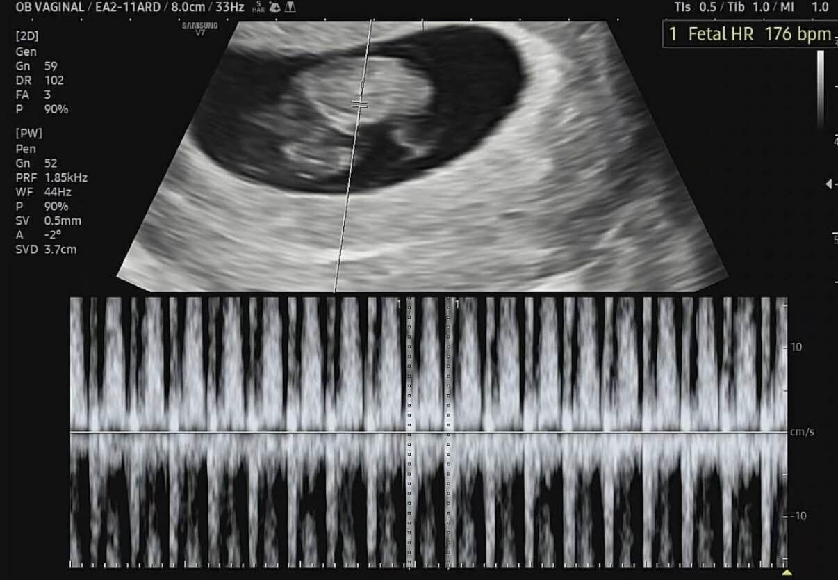 Is 8 Weeks Pregnant with a Strong Heartbeat Still at Risk for Miscarriage?