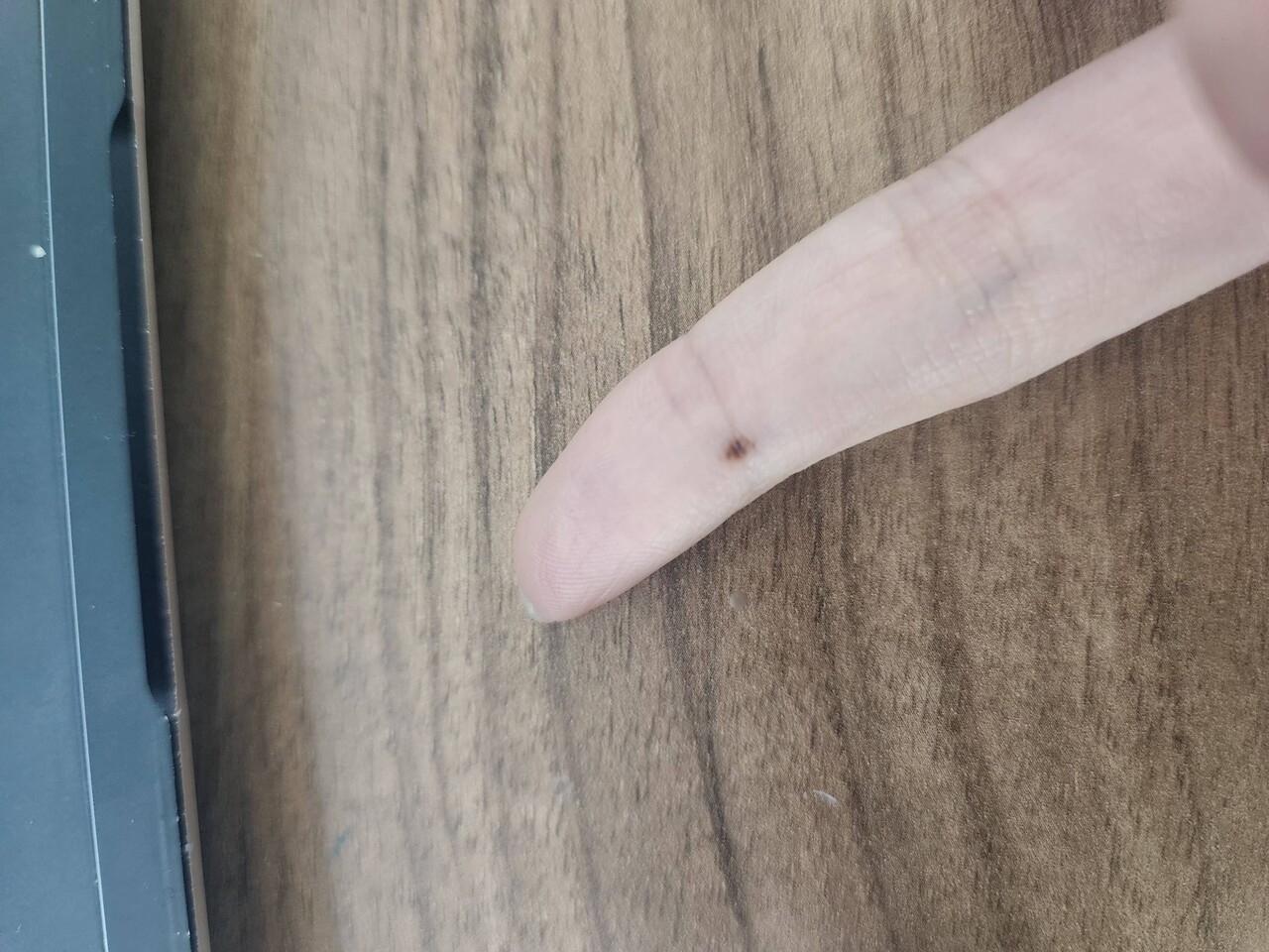 블라인드 | 의료·시술: 이거 혹시 흑색종일수도 있음?