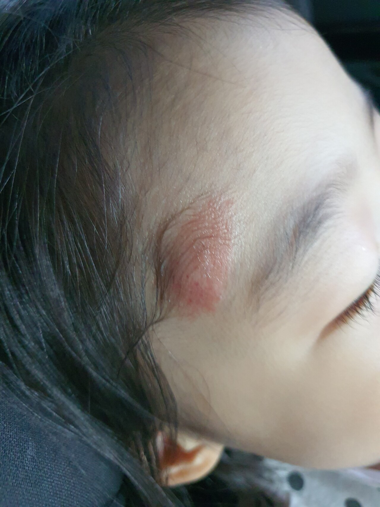 블라인드 | 육아: 아이 벌레 물린 자국 한 번 봐주시겠어요?