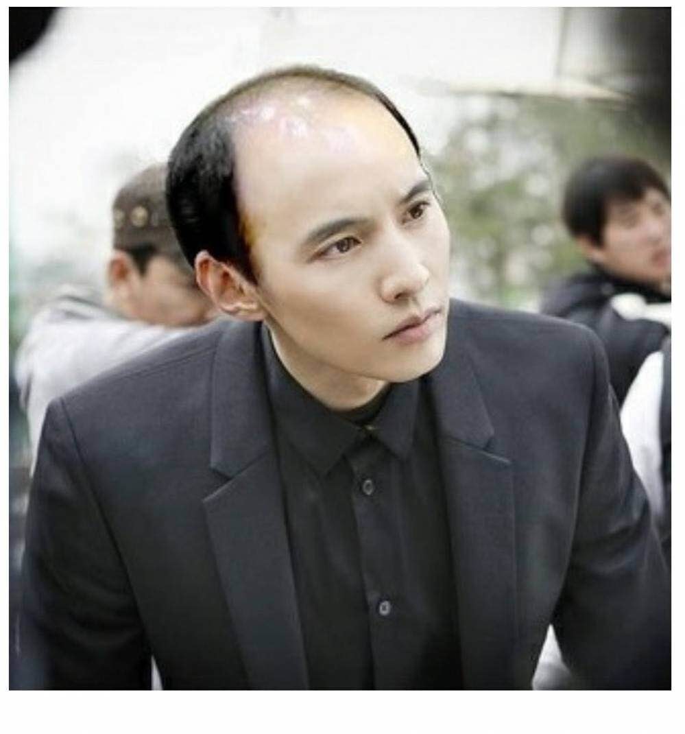 블라인드 | 블라블라: 잘생긴 원형탈모 vs 못생긴 남자