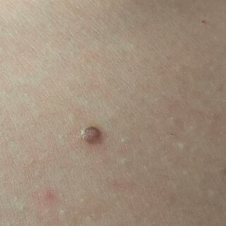 병원 가보긴 할건데 피부암!!!