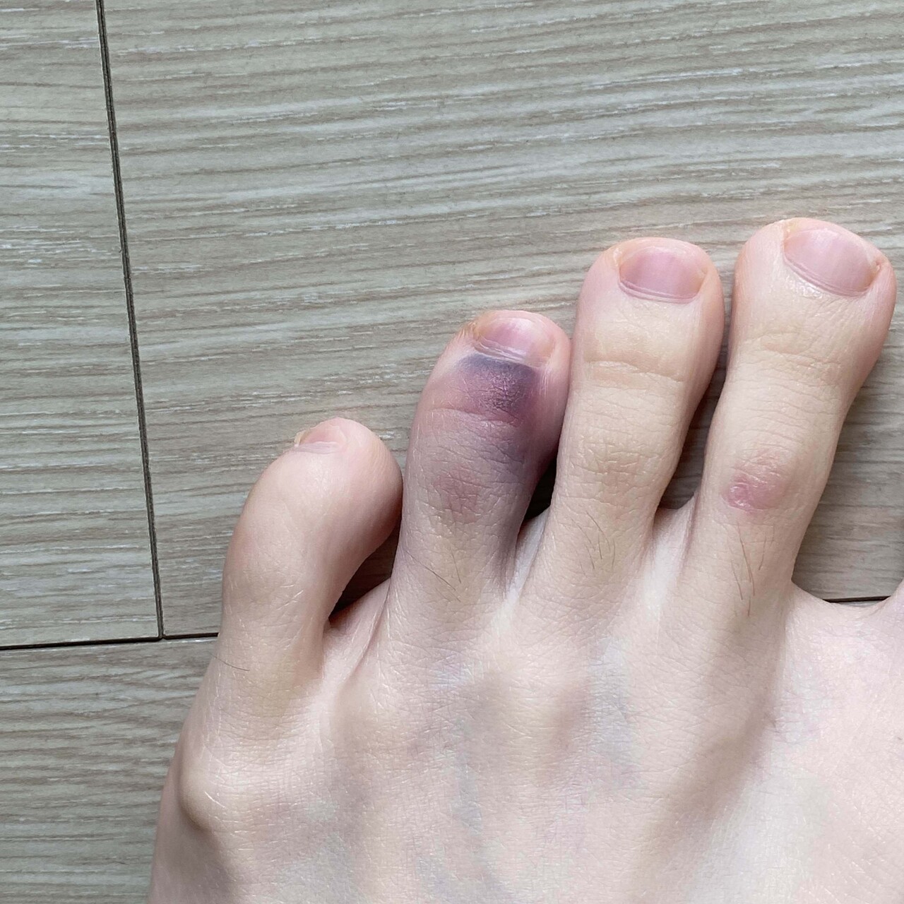 블라인드 | 블라블라: 아파