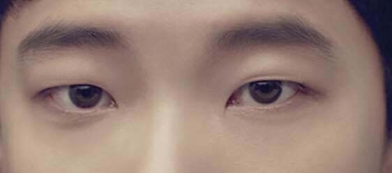 블라인드 | 블라블라: 무쌍 찢어진 눈 vs 속쌍 눈