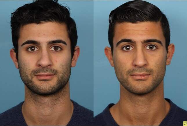 Is Rhinoplasty worth it?
