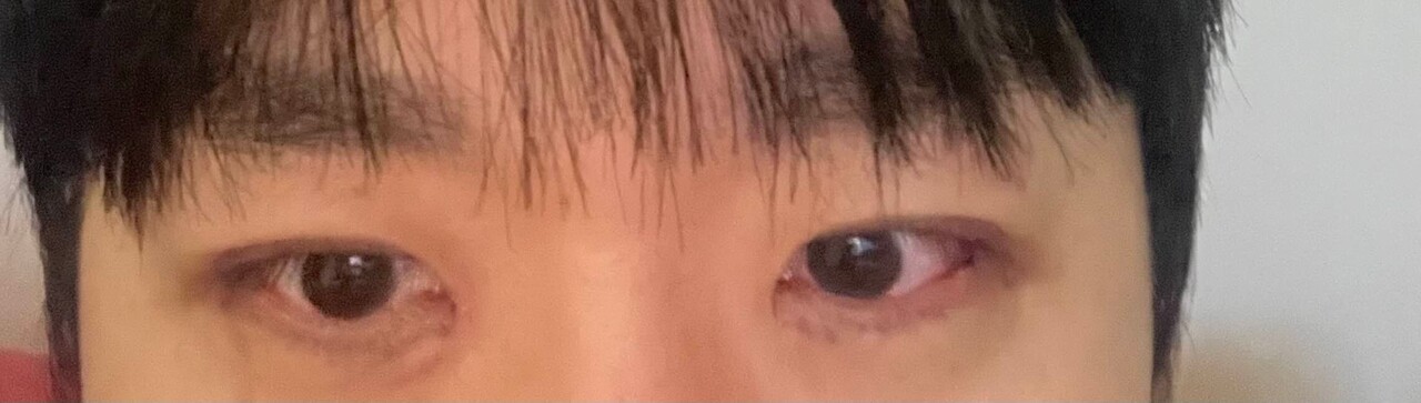 블라인드 | 의료·시술: 속쌍 눈매교정 전vs후 뭐가나음