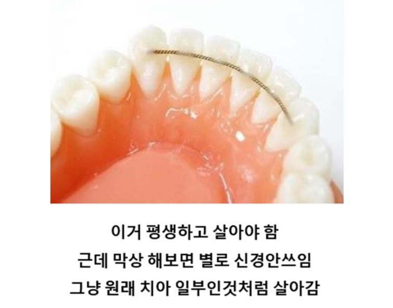 블라인드 | 블라블라: 치아교정 유지장치 궁금한 점