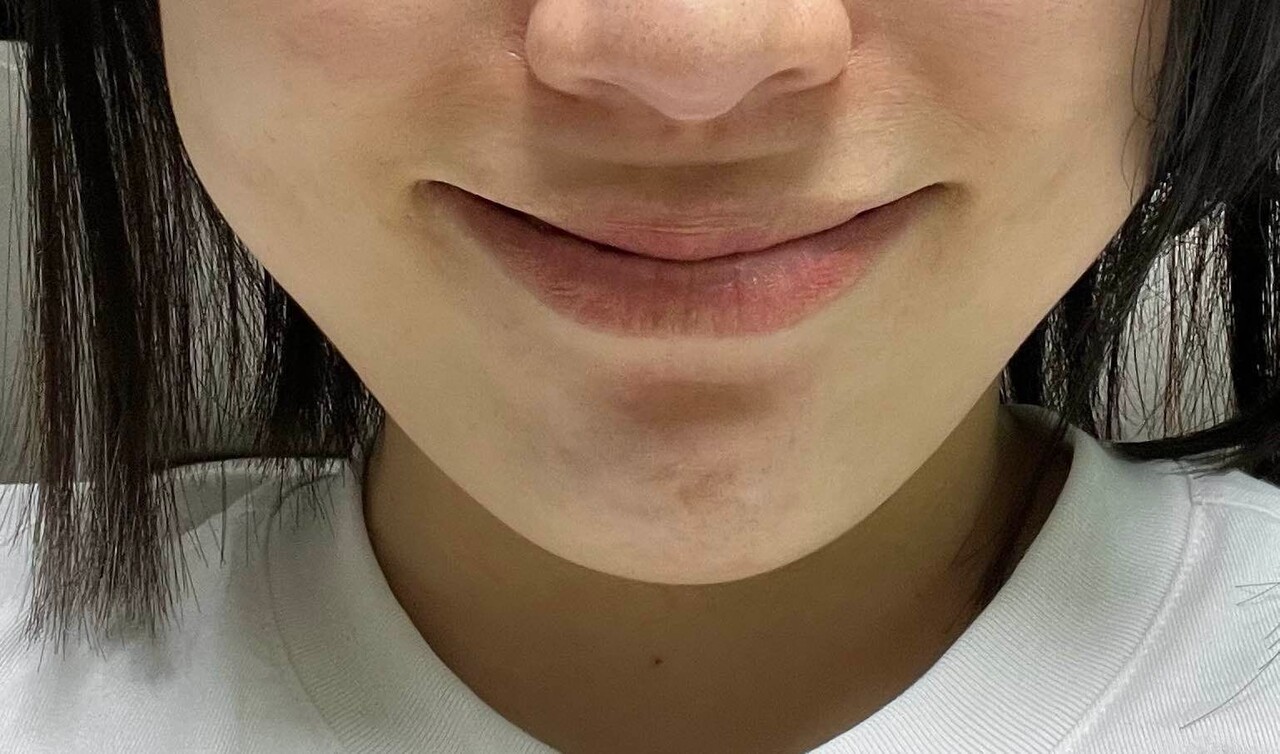 아이본성형외과 2025년 최신 후기, 눈성형·재수술 어떤 점이 달라졌을까?